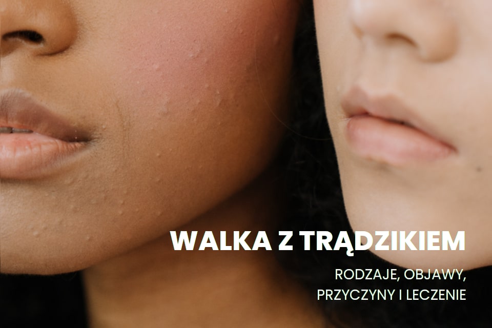 Jak walczyć z trądzikiem