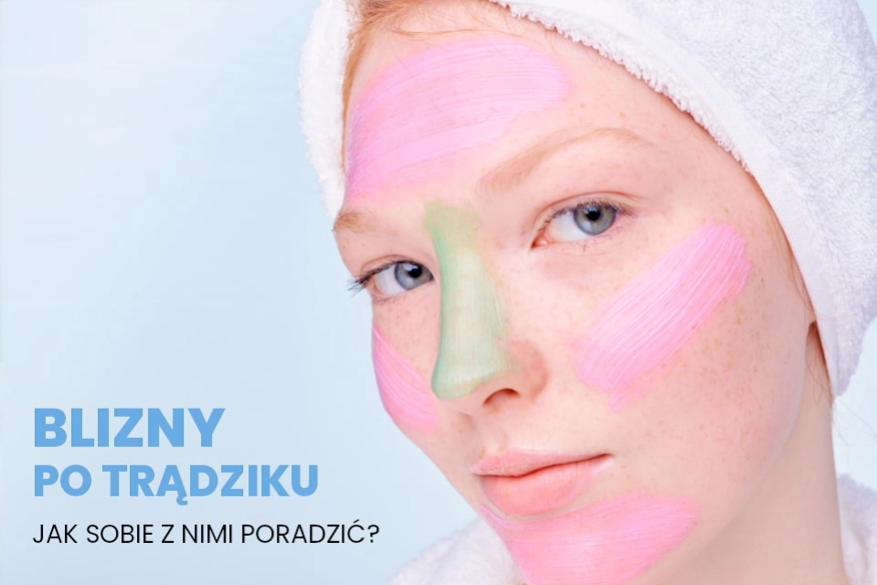 Blizny po trądziku – jak sobie z nimi poradzić?
