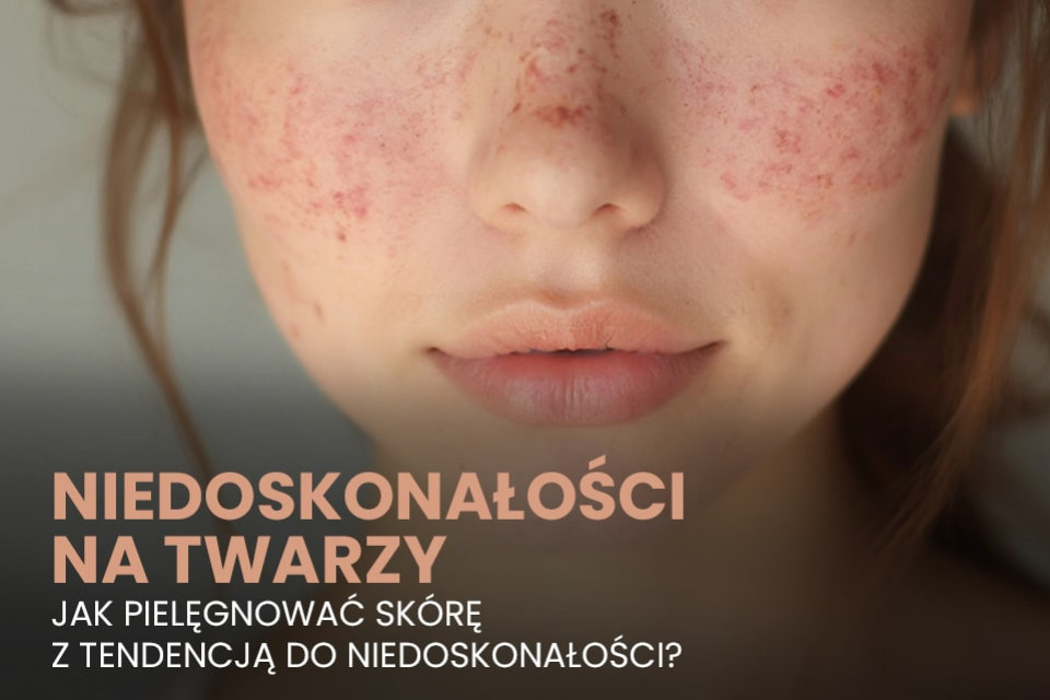 Niedoskonałości na twarzy — jak pielęgnować skórę z tendencją do niedoskonałości